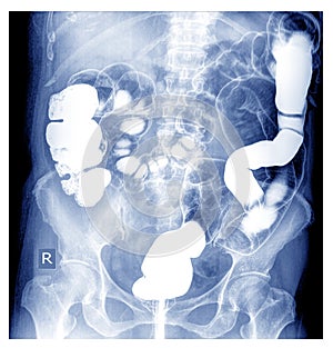 Special X-ray Barium Enema