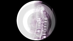 Special X-ray Barium Enema Collection Congenital megacolon with transitional zone at lower descending colon.