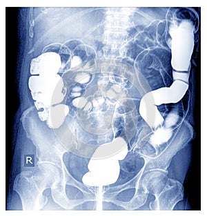 Special X-ray Barium Enema photo