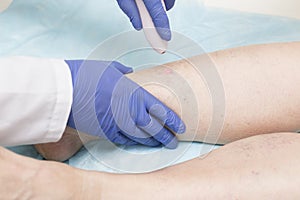Specialist doctor conducts endovenous laser coagulation of the veins of the lower extremities. The concept of treatment for