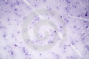 Sperm morphology. Semen photo under microscope