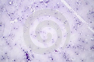 Sperm morphology. Semen photo under microscope