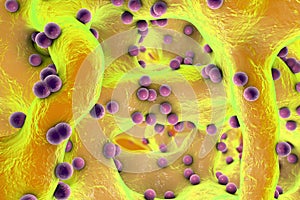 Spherical bacteria inside bone tissue