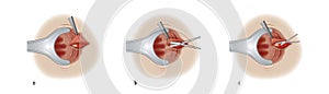 Sphincterotomy procedure for anal fissure