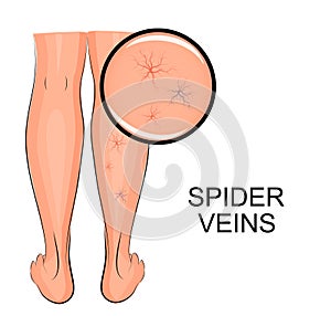 Spider veins on legs