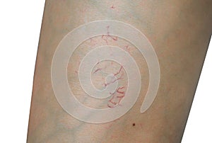 Spider veins on woman leg skin on white background. Concept before sclerotherapy or laser surgery to remove spider veins