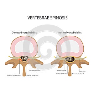 Spin stenosis. vertebrae disease photo