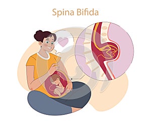 Spina Bifida concept. photo