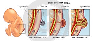 Spina bifida illustration