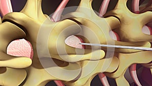 Spinal Anaesthesia