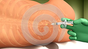 Spinal Anaesthesia