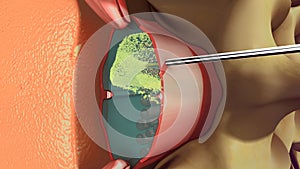 Spinal Anaesthesia