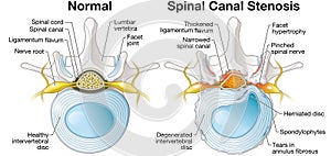 Spinal Canal Stenosis. Lumbar vertebra with intervertebral disc and herniated nucleus pulposus, illustration