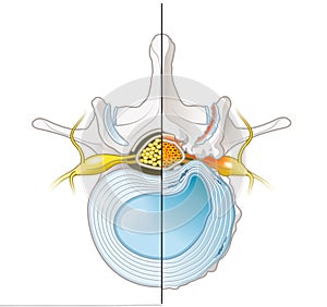 Spinal Canal Stenosis. Lumbar vertebra with intervertebral disc and herniated nucleus pulposus, illustration