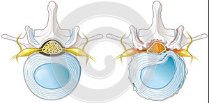 Spinal Canal Stenosis. Lumbar vertebra with intervertebral disc and herniated nucleus pulposus, illustration photo