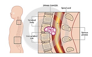 Spinal cancer illustration