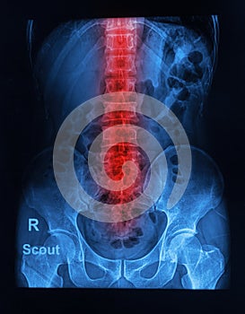 Spinal column x-ray image