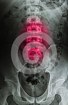 Spinal column x-ray image