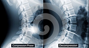 Spinal Compression and Decompression X-Ray