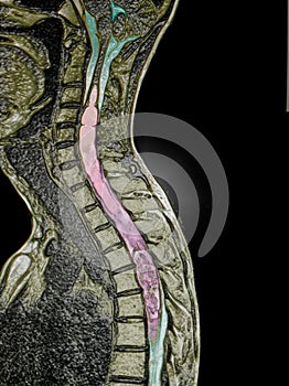 spinal cord tumor, illustration, MRI