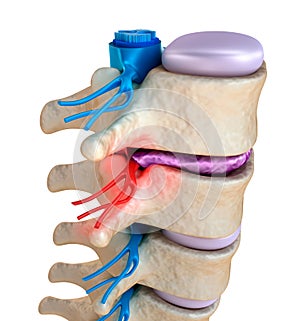 Spinal cord under pressure of bulging disc