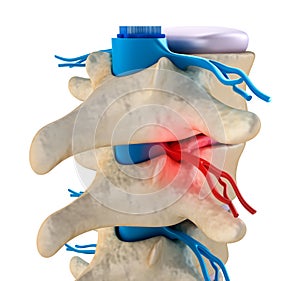 Spinal cord under pressure of bulging disc