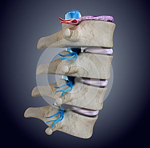 Spinal cord under pressure of bulging disc