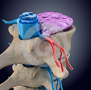 Spinal cord under pressure of bulging disc