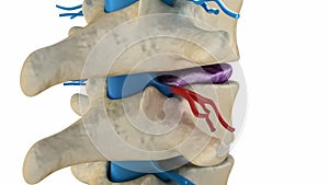 Spinal cord under pressure of bulging disc