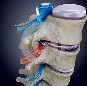 Spinal cord under pressure of bulging disc