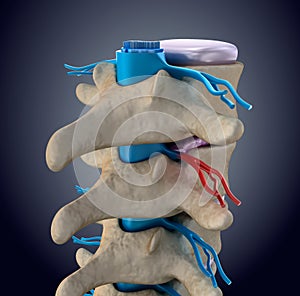 Spinal cord under pressure of bulging disc photo