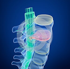 Spinal cord under pressure of bulging disc, X-Ray view.