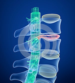 Spinal cord under pressure of bulging disc, X-Ray view.