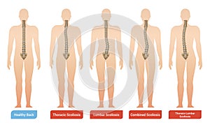 Spinal Curvature Infographic Set