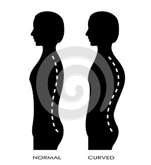 Spinal curvature photo