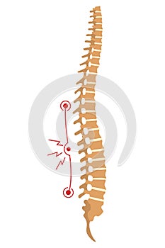 Spinal deformity. Symbol of spine curvatures or unhealthy backbones. Human spine anatomy, curved spine. Diagram with