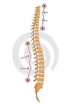 Spinal deformity. Symbol of spine curvatures or unhealthy backbones. Human spine anatomy, curved spine. Diagram with