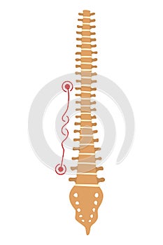 Spinal deformity. Symbol of spine curvatures or unhealthy backbones. Human spine anatomy, curved spine. Diagram with
