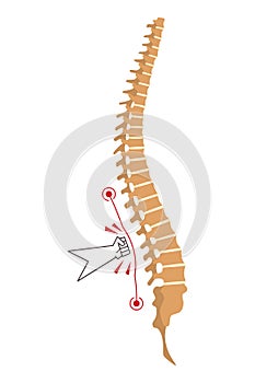 Spinal deformity. Symbol of spine curvatures or unhealthy backbones. Human spine anatomy, curved spine. Diagram with