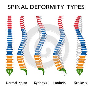 Spinal deformity types.