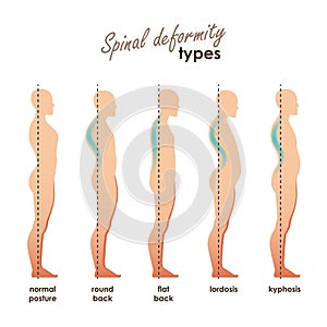 Spinal deformity types. Diseases of the spine.Lordosis, kyphosis, round back, flat back. Vector human silhouettes