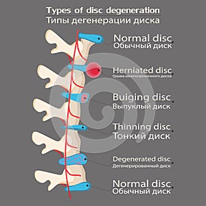 Spinal disc degeneration illustration, educational medical illustration, spine disease options, flat style, idea for your