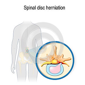 Spinal disc herniation