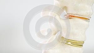 Spinal disc herniation as close-up as 3D Rendering