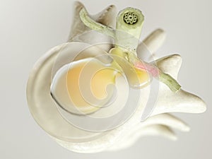 Spinal disc herniation as close-up detailed 3D Rendering