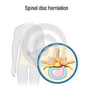 Spinal disc herniation photo