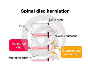 Spinal disc herniation illustration photo