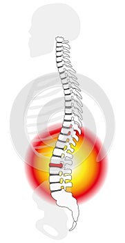 Spinal Disc Prolapse Herniation
