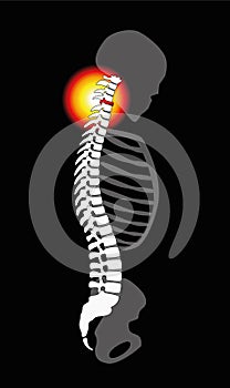 Spinal Disc Prolapse Neck Pain Cervical Vertebrae photo