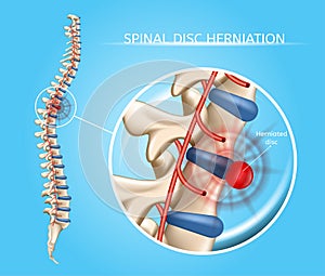 Spinal Disk Herniation Vector Medical Scheme